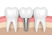 Teeth Implant